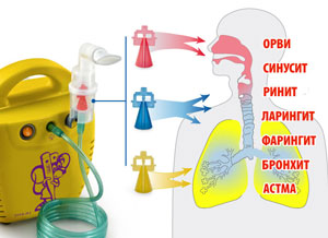 Ингалятор Little Doctor LD 211С компрессорный (3 распылителя)